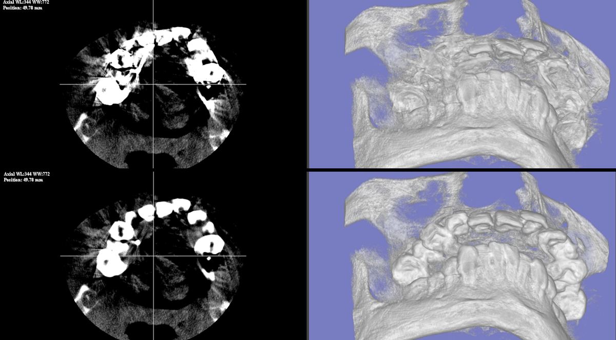 D-MAR 金属アーチファクト低減 Before/After CT画像