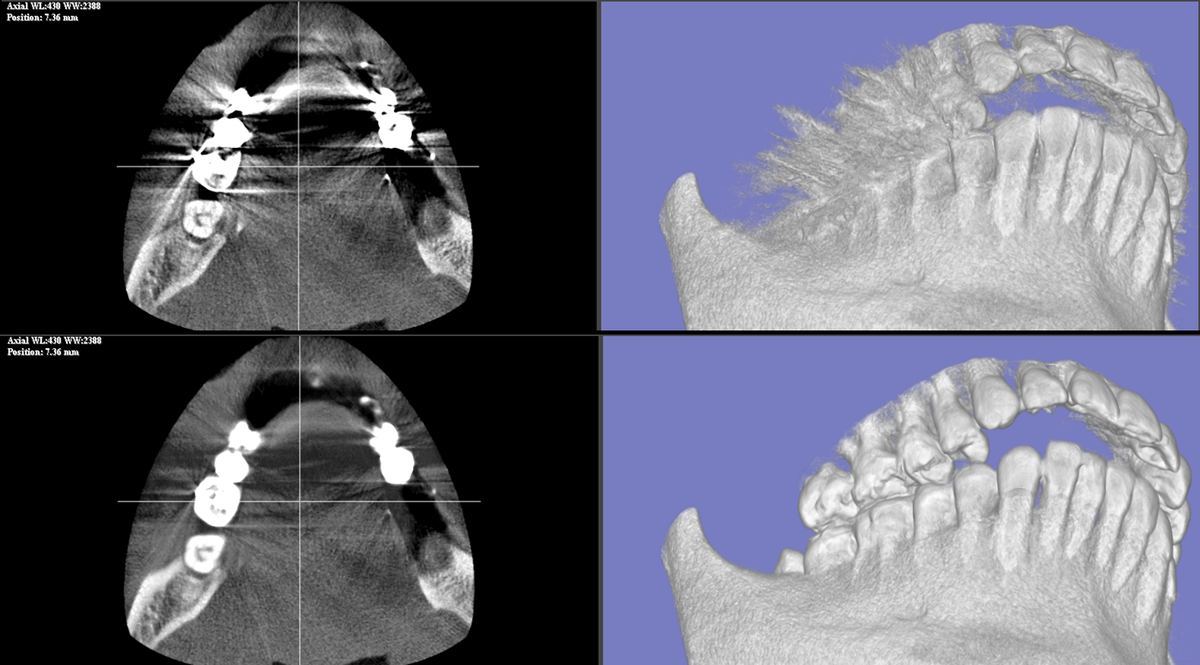 D-MAR 症例A Before/After