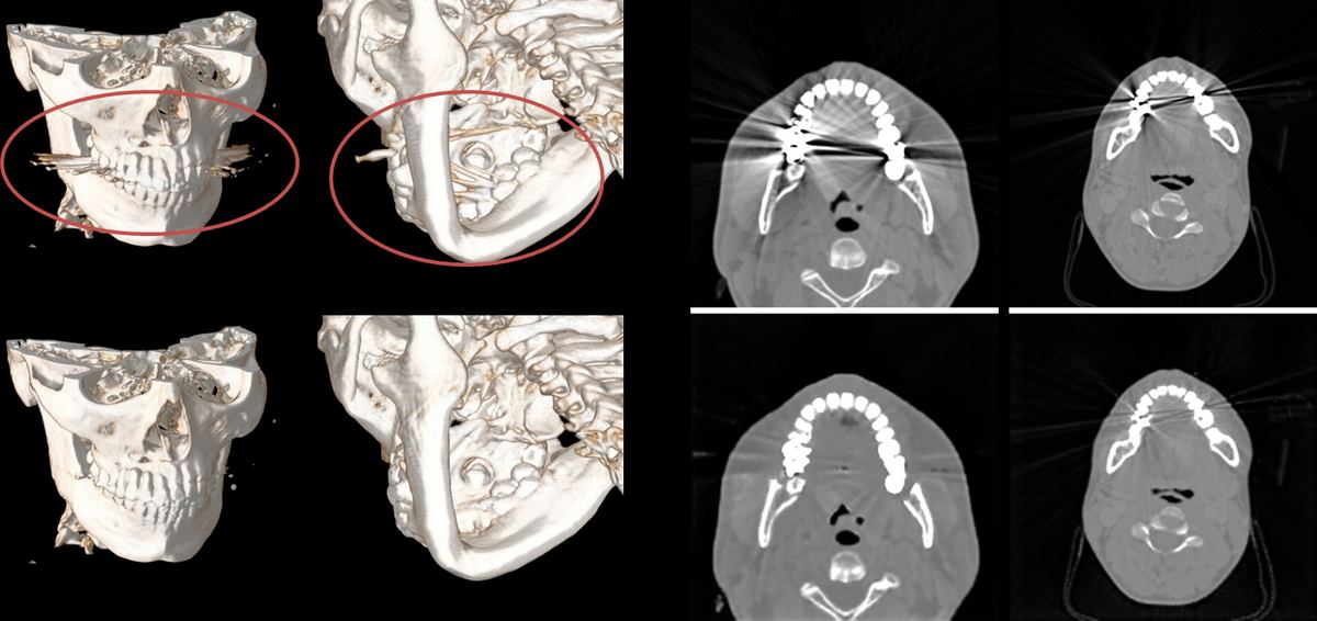 顎骨CT 金属アーチファクト典型症例