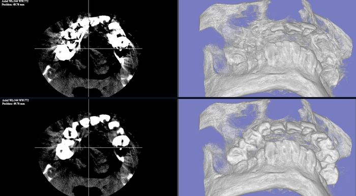Growth RTV D-MARアーチファクト低減