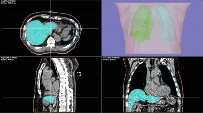 Growth RTV AI臓器自動抽出