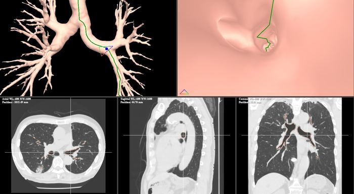 Growth RTV VBN気管支ナビゲーション