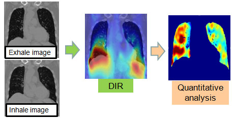 iVAS - 肺機能評価画面
