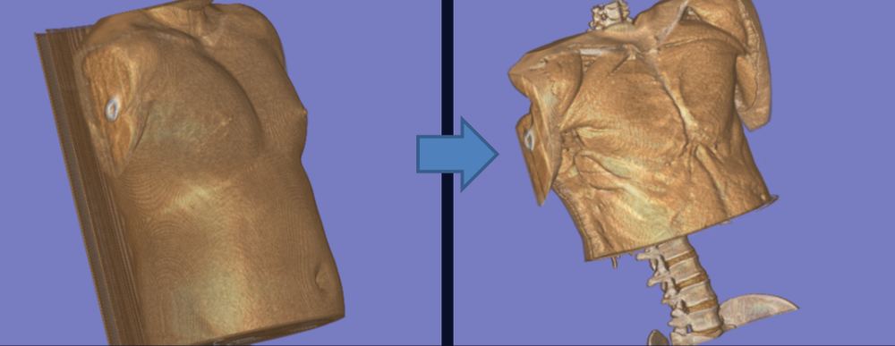 乳房切除術 患者説明支援アプリ - 3D術後予測ビジュアライゼーション